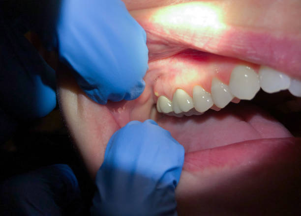 Best Emergency Wisdom Teeth Removal in Pearl River, LA