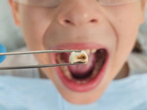 Best Urgent Care for Lost Fillings or Crowns in Pearl River, LA
